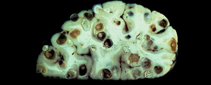 parenchymal cysts
