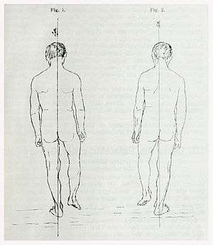 Bell's palsy - Wikipedia