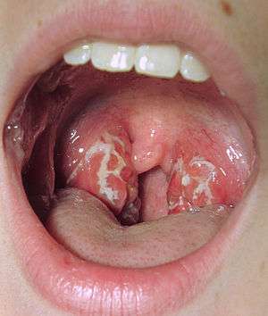 prostatitis tonszillitis hogyan lehet meghatározni a prosztatagyulladást a férfiaknál