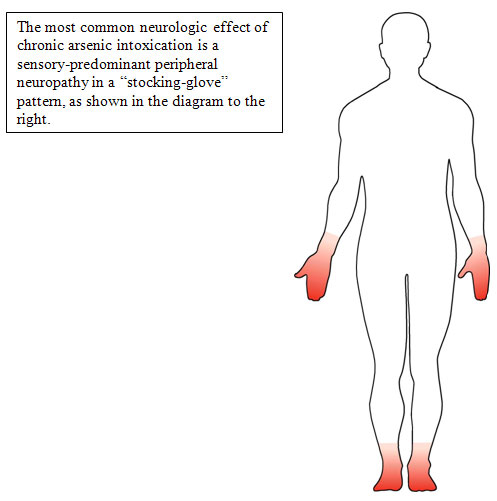 diagram illustrating a sensory-predominant peripheral neuropathy in a stocking-glove pattern