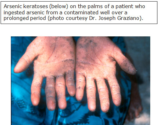 arsenic keratoses on the palms of a patient