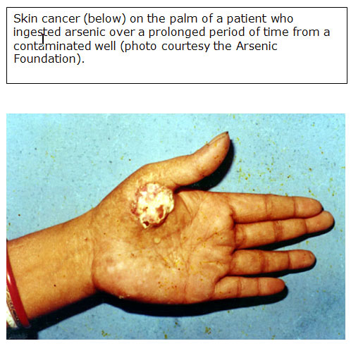 skin cancer on the palm of a patient
