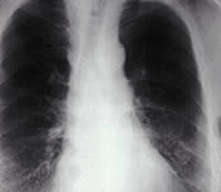 Figure 5. Chest radiograph
 of asbestosis in the lung