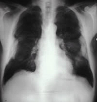 Figure 6. Chest radiograph showing bilateral pleural plaques