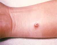 image of a small cutaneous anthrax ulcer just below a patient's wrist