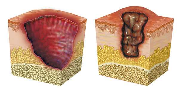 Graphic of a skin section with ulcer.