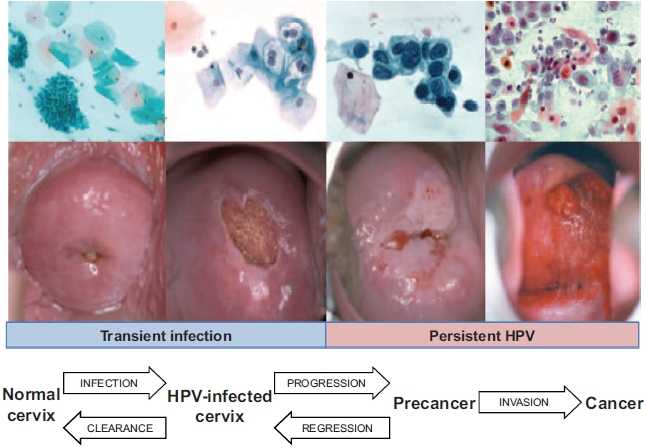 Cervical cancer progression model. The functional progression model is displayed at the bottom. Classical cytological and colposcopic correlates of normal cervix, human papillomavirus (HPV)-infected cervix, precancer, and cancer are displayed.