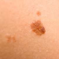 Photo of skin moles or spots