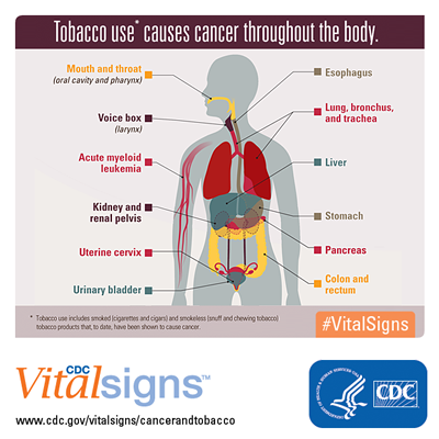 Tobacco use causes cancer throughout the body. Mouth and throat (oral cavity and pharynx); esophagus; voice box (larynx); lung, bronchus, and trachea; acute myeloid leukemia; liver; kidney and renal pelvis; stomach; uterine cervix; pancreas; colon and rectum; and urinary bladder. Tobacco use includes smoked (cigarettes and cigars) and smokeless (snuff and chewing tobacco) tobacco products that, to date, have been shown to cause cancer.