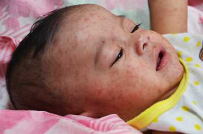 Infant with the measles