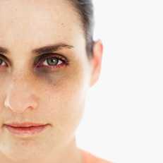 Photo: Adult woman with a black eye
