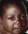 Chickenpox in unvaccinated child.