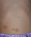 Breakthrough varicella on the abdomen of a vaccinated child.