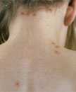 Breakthrough varicella on the neck and back of a vaccinated child.