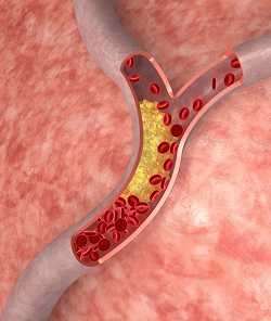 Image of cholesterol in the arteries.