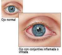 ilustracin de ojo normal y ojo irritado