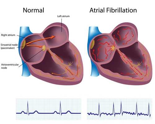 In the normal heart, the electrical activity proceeds in an organized manner, going from the atrium and into the ventricles. In a heart with atrial fibrillation, the electrical activity occurs in an unorganized manner rather than being sequential. The irregular line in the electrocardiogram on the right reflects the disorganized electrical activity producing the fine (fibrillating) wavy lines.