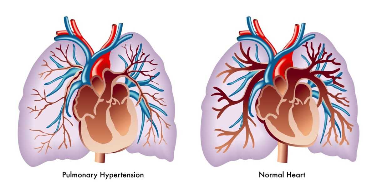 Picture on the left shows the heart, lungs, and pulmonary blood vessels with a narrowed pulmonary artery leading from the heart to the lungs and an enlarged right ventricle. These changes occur in pulmonary hypetension. The picture on the right shows a normal heart, lungs, and pulmonary blood vessels without any narrowed blood vessels.