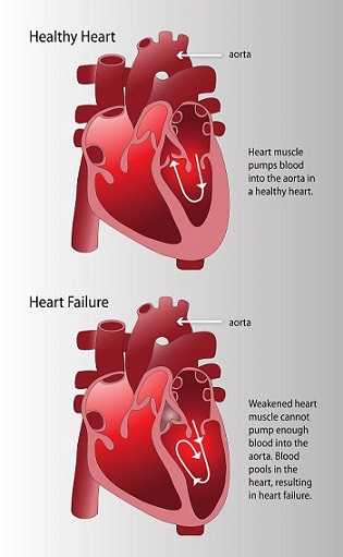Image shows a healthy heart where the aorta is pumping blood into the heart muscle, and in contrast, a heart with heart failure where the weakened heart muscle cannot pump enough blood into the aorta. Blood pools in the heart, resulting in heart failure.