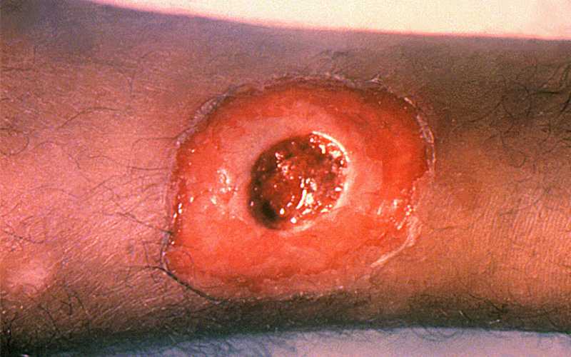 A diphtheria skin lesion on the leg