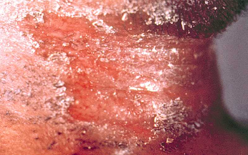 Diphtheria skin lesion on the neck