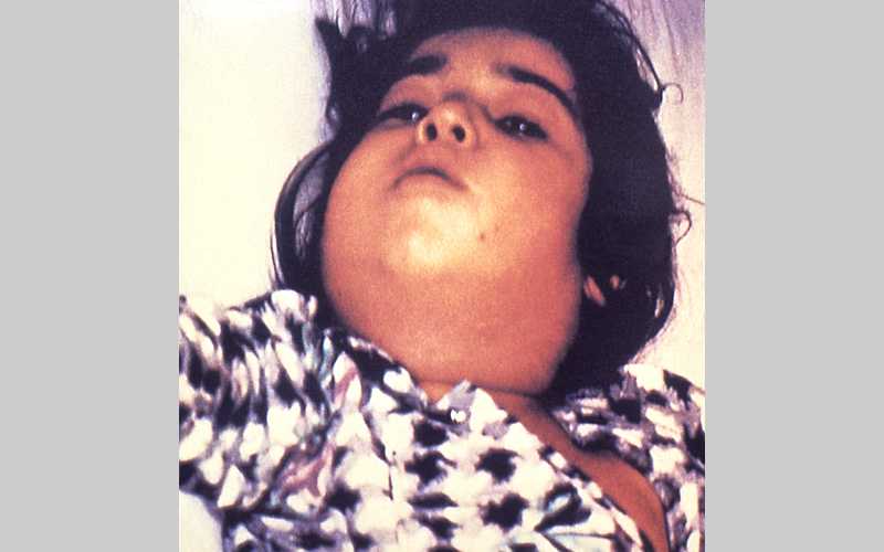 Child with diphtheria showing a characteristic swollen neck, sometimes referred to as “bull neck”