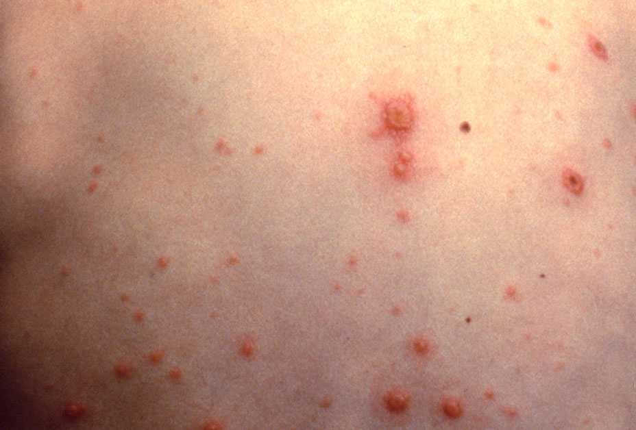 Chickenpox Symptoms