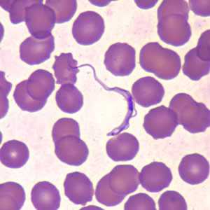	Trypanosomiasis, African