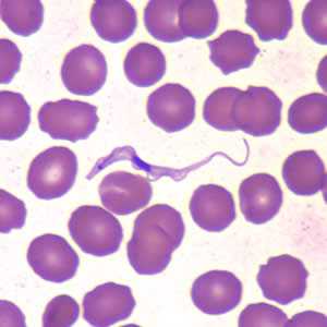 	Trypanosomiasis, African