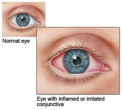 Illustration of a normal eye compared to an eye with inflamed or irritated conjuctiva