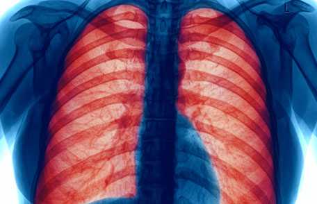 The Burden of COPD
