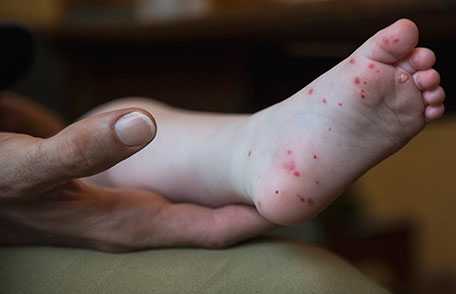 Hand, Foot & Mouth Disease