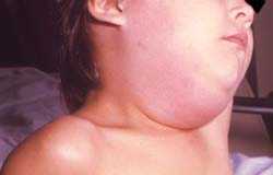 Young boy with mumps