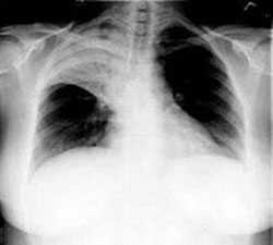 Chest x-ray of an adult patient with pneumonia