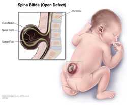 Graphic: Spina Bifida (Open Defect)