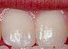 Image of very mild fluorosis. Teeth with small, paper-white opaque spots over a small area.