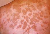 	Erupción en la piel (eritema nudoso) debido a la fiebre del valle