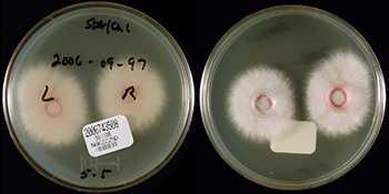 	Two sides of a Petri dish containing left and right contact lenses from a patient with Fusarium keratitis