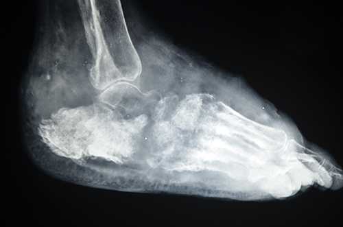 X-ray of foot eumycetoma showing massive soft tissue, periosteal reaction at the lower tibia, and multiple bone cavities involving most of the foot bones. Photo by Dr. Ahmed Fahal, Mycetoma Research Center, Khartoum, Sudan
