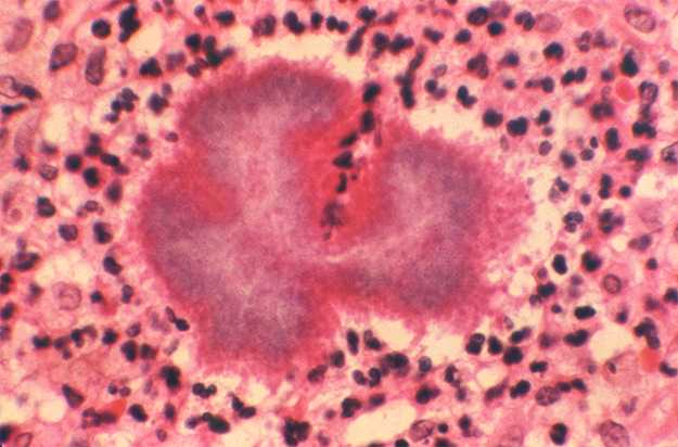 Hematoxylin-eosin (H and E) stained photomicrograph of a tissue sample of a mycetoma excised from a patient’s thorax due to the bacterium Nocardia brasiliensis.