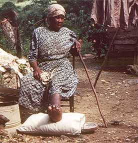 Woman with mycetoma in West Indies