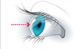 	A graphic with an arrow pointed to a cornea.