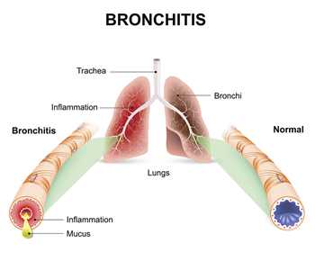 Bronchitis occurs when the airways of the lungs swell and produce mucus. That’s what makes  you cough