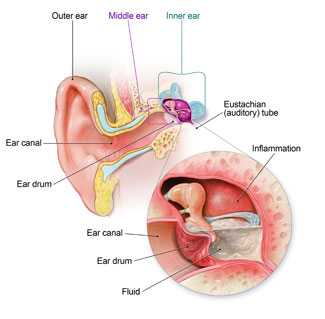 Anatomy of the ear showing where fluid builds up in the middle ear and puts pressure, or pushes, on the ear.