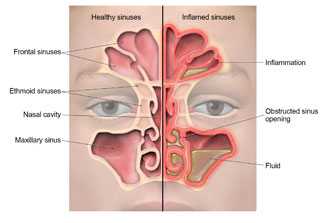 Anatomy of the sinuses, showing where inflammation occurs and fluid builds up during a sinus infection.