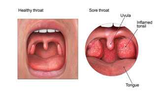 When you have a sore throat, your tonsils often hurt and are usually red and swollen.