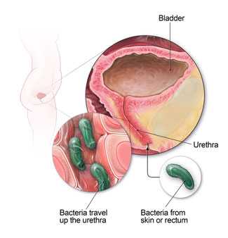 Anatomy of the urinary tract, showing how bacteria can cause an infection.