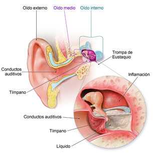 Diagrama del oído que muestra dónde se acumula el líquido en el oído medio y dónde ejerce presión.