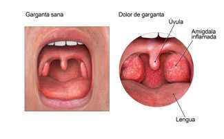 Diagrama de la boca que muestra las amígdalas inflamadas durante un dolor de garganta.