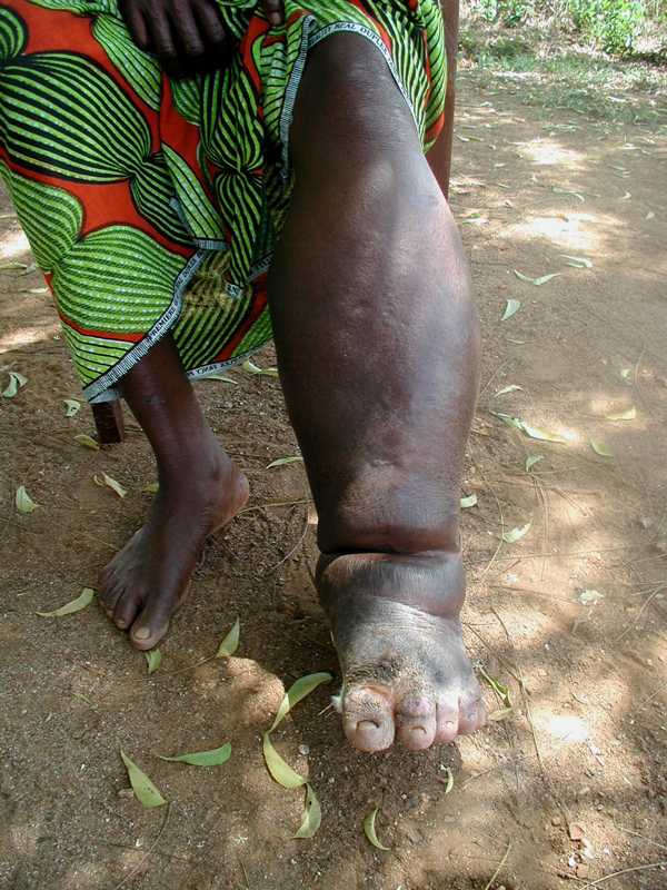 Neglected Tropical Disease in Ghana